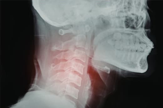 Cervical spine X-ray highlighting neck pain